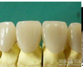 烤瓷牙制作视频,全程视频解析